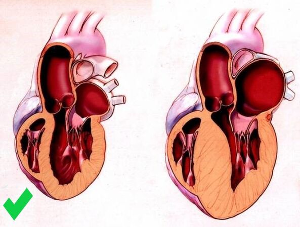 Το Cardione αποτρέπει την κοιλιακή υπερτροφία της καρδιάς